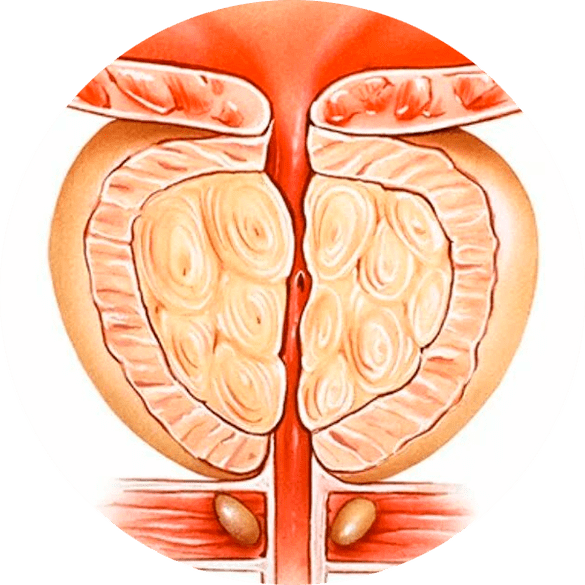 As a result of untreated prostatitis