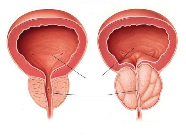 healthy and diseased prostate