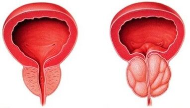 healthy prostate and inflamed with prostatitis